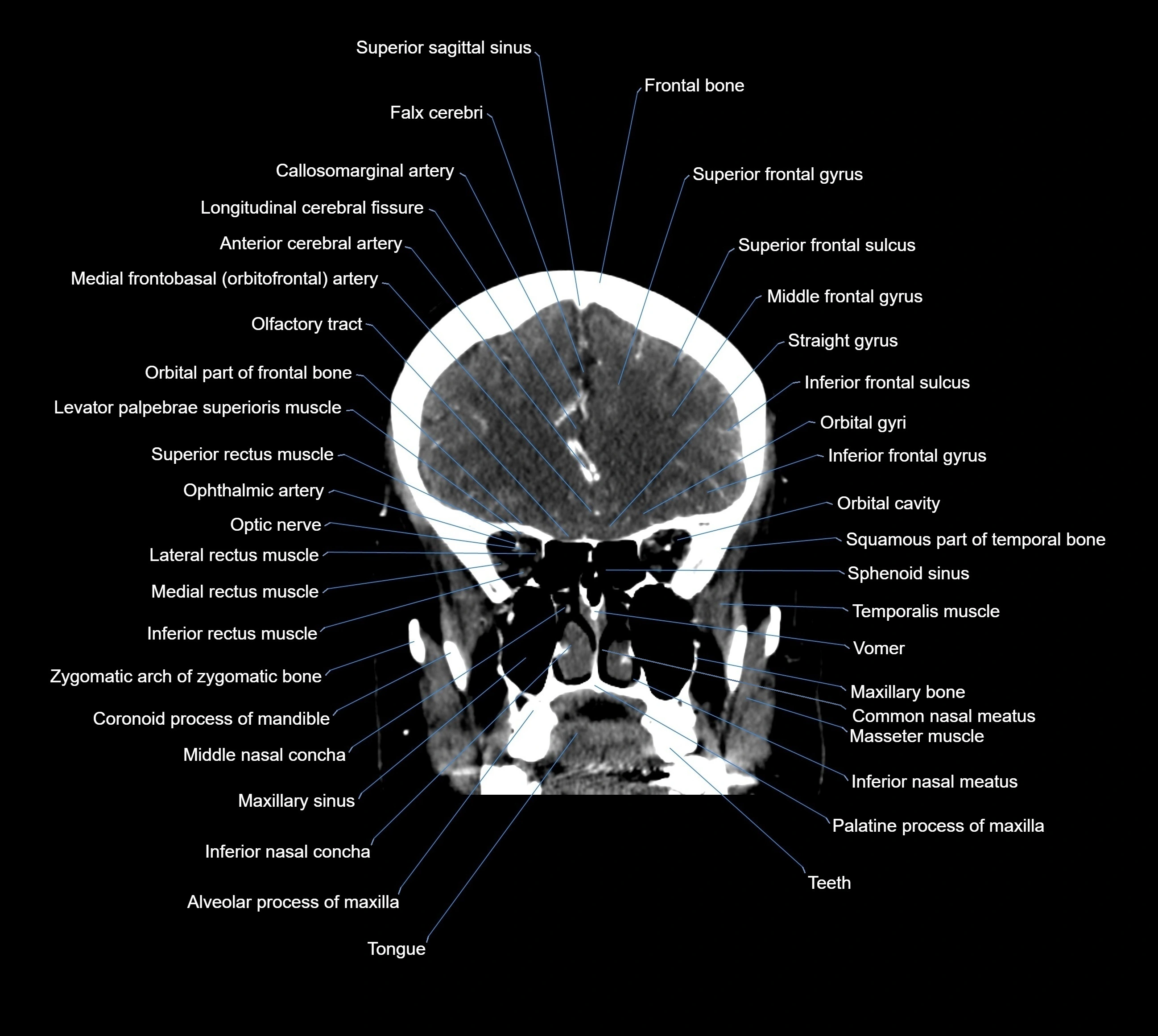 CT Brain coronal cross sectional radiology anatomy image  -img-00001-015.webp